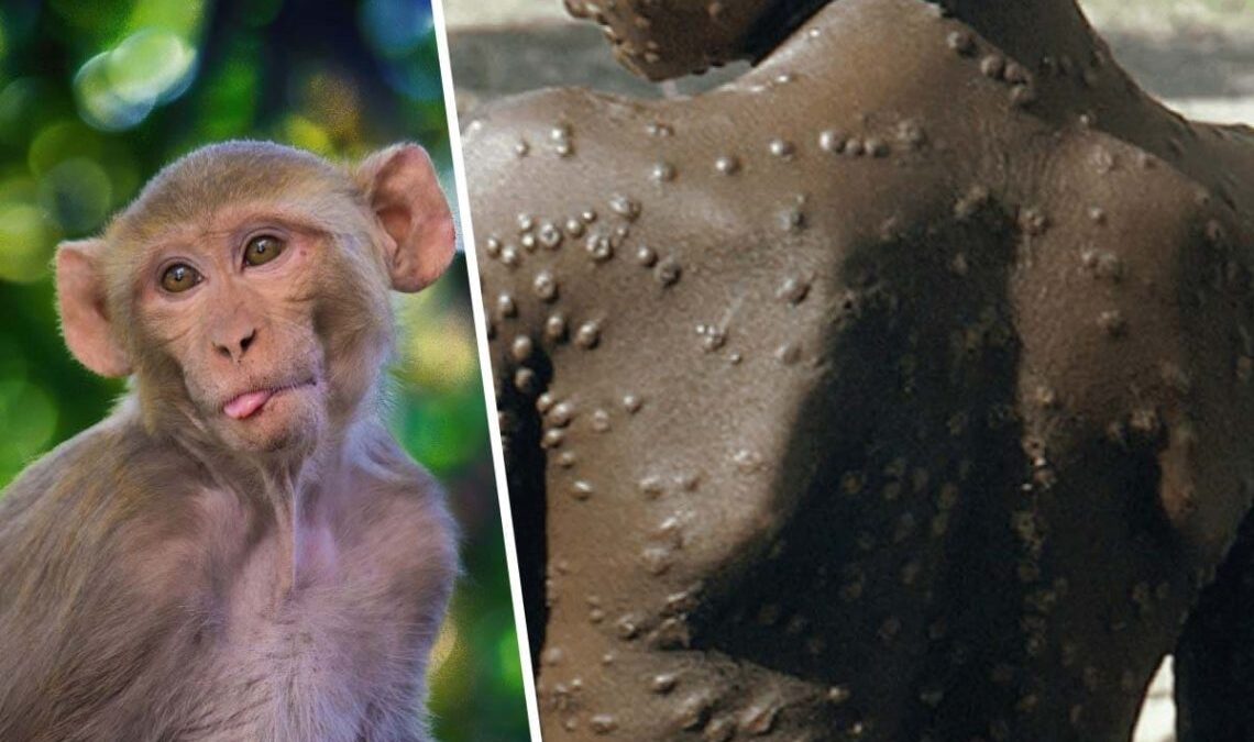 Autoridades de Nueva York aseguran no preocuparse por la viruela del mono