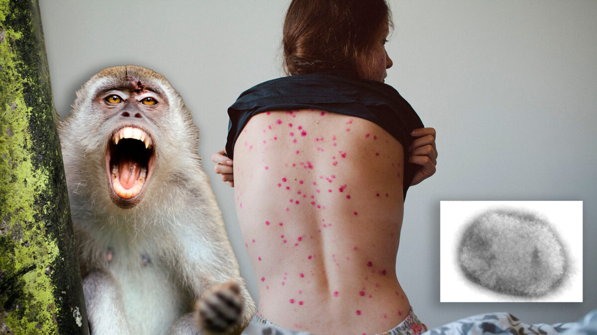 Argentina reporta el cuarto caso de la viruela del mono