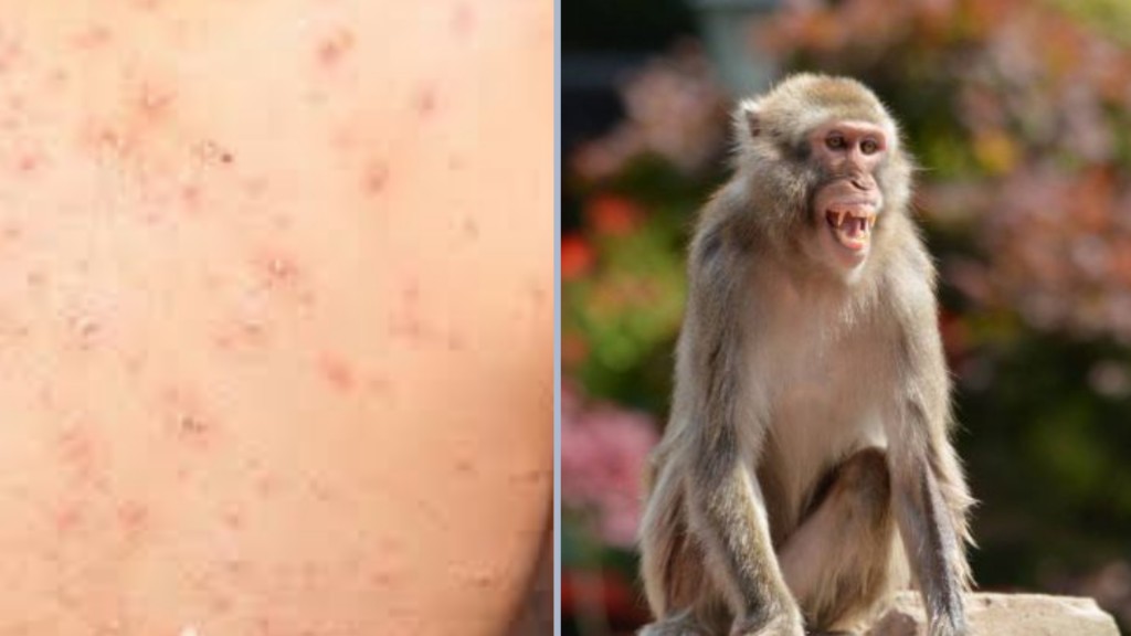 África reporta más de 2 mil casos de viruela del mono y 75 fallecimientos  