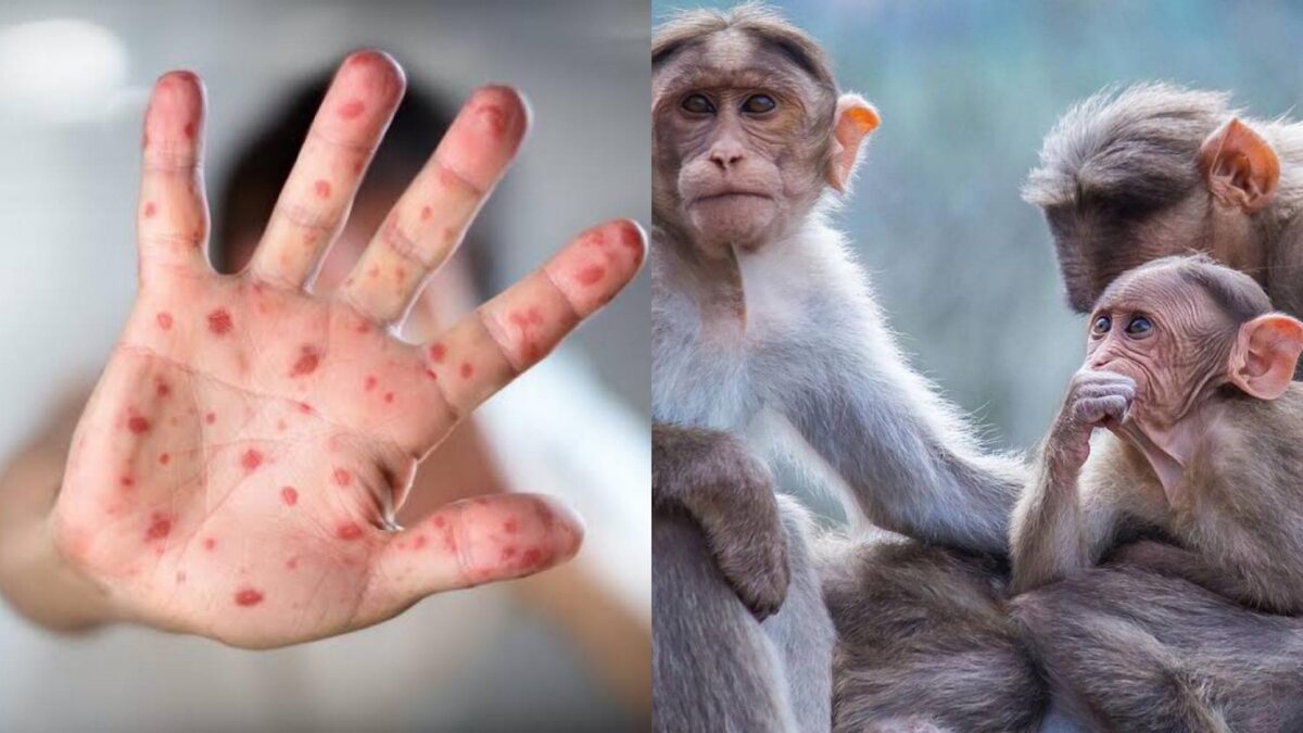 El Salvador: confirman caso de viruela del mono, el primero en Centroamérica