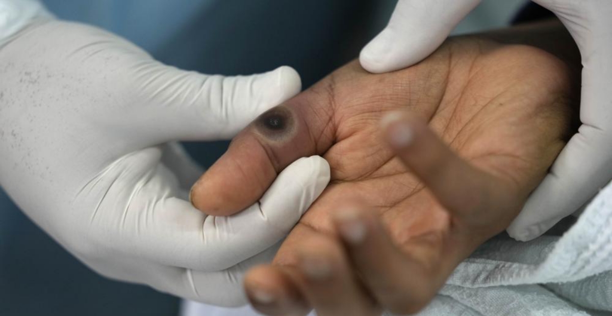 Registran 93 enfermos de viruela símica en Bolivia
