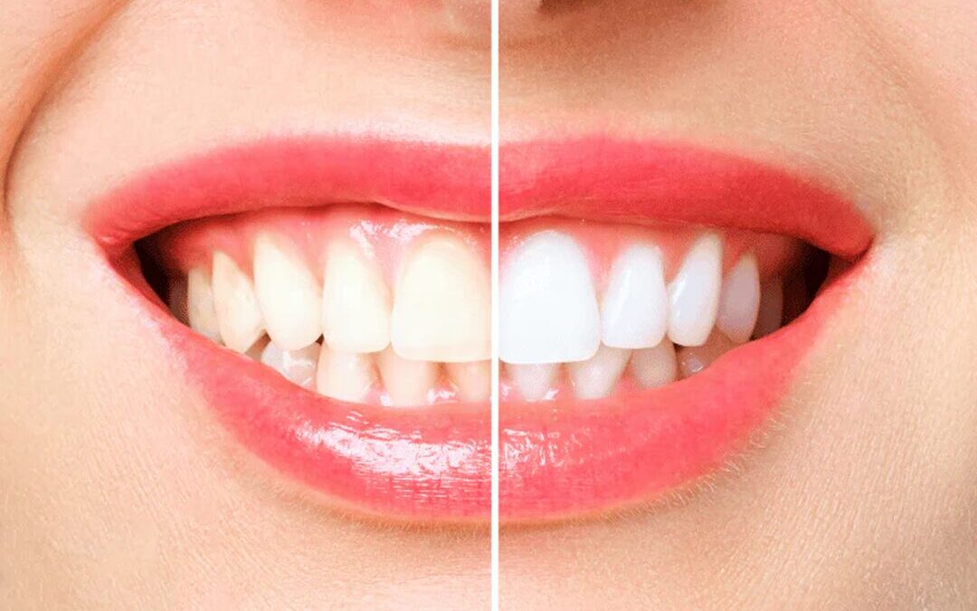 Blanqueamiento dental: el procedimiento que mejora tu sonrisa